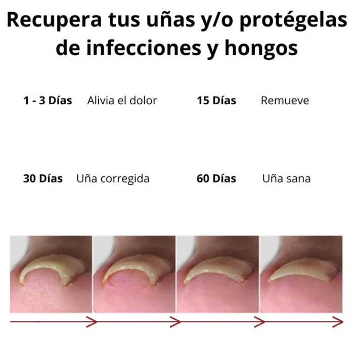 Tratamiento para eliminar Hongos de uña 100% Natural🍃
