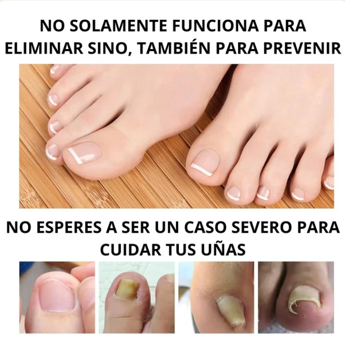 Tratamiento para eliminar Hongos de uña 100% Natural🍃