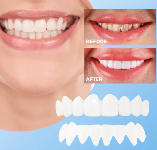 Montura Carillas Dentales