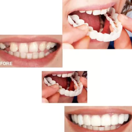 Montura Carillas Dentales